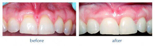 Connective tissue graft periodontal surgery results at DentiCare India