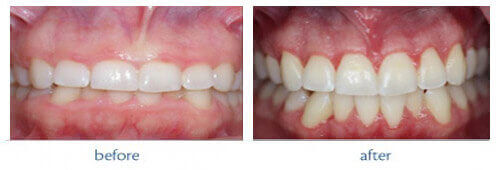 Esthetic crown lengthening periodontal plastic surgery at DentiCare India