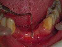 Free gingival graft around dental implants before treatment at DentiCare India