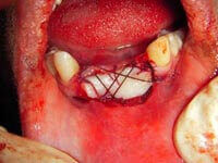 Free gingival graft around dental implants intermediate stage at DentiCare India