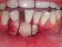Free gingival graft intermediate stage procedure at DentiCare India