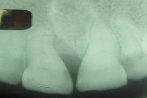 Alveolar bone restoration after bone grafting treatment