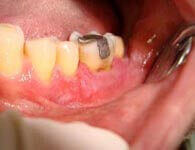 After successful guided tissue regeneration treatment