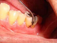 Before guided tissue regeneration procedure at DentiCare India