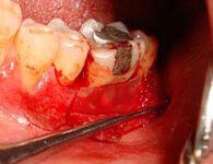 Pre-operative guided tissue regeneration dental view