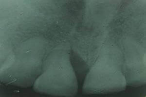 Lost alveolar bone condition before bone grafting procedure
