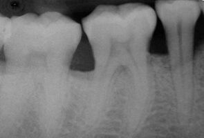 Postoperative healing result after bone grafting procedure