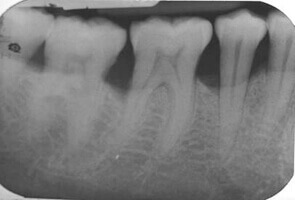 Preoperative view of alveolar bone defect for grafting